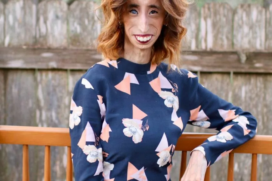 Meet One of The Most Beautiful Women of the World Lizzie Velasquez